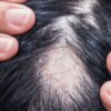 Five Causes of Hair Loss and Resources for Assistance