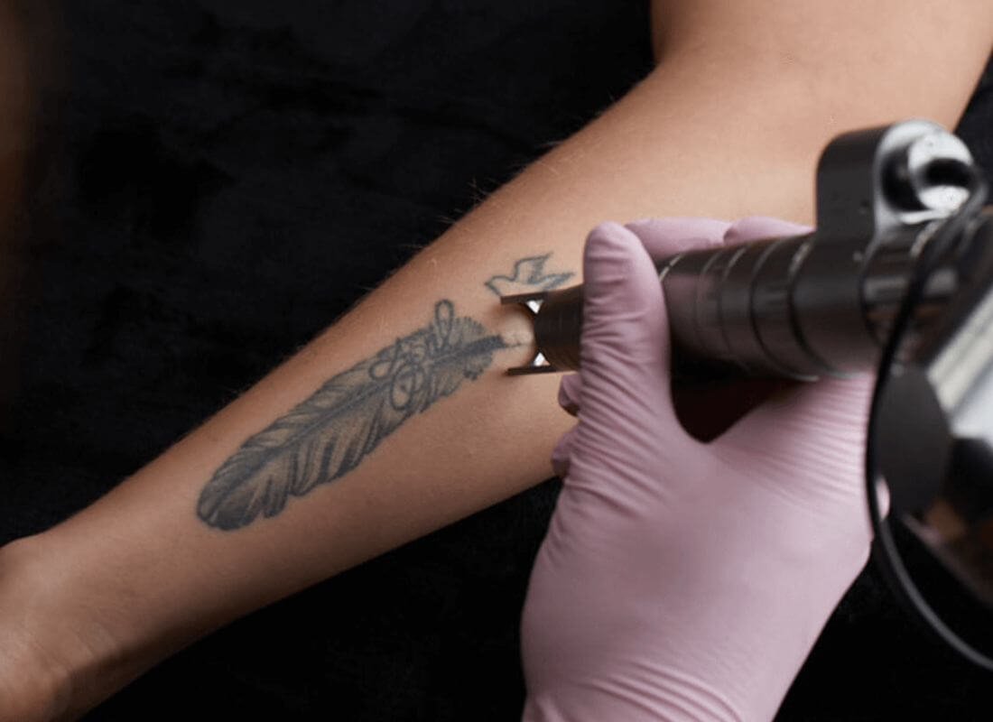 THE REASONS LONDON IS THE DESTINATION CITY FOR LASER TATTOO REMOVAL