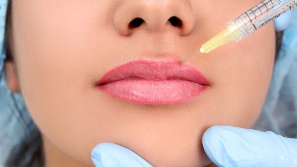 Lip Fillers and Beyond The Evolution of Dermal Fillers